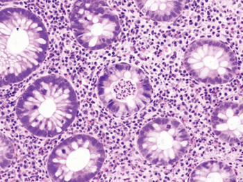 Image: Histopathological image of the active stage of ulcerative colitis (Photo courtesy of Wikipedia Academy).